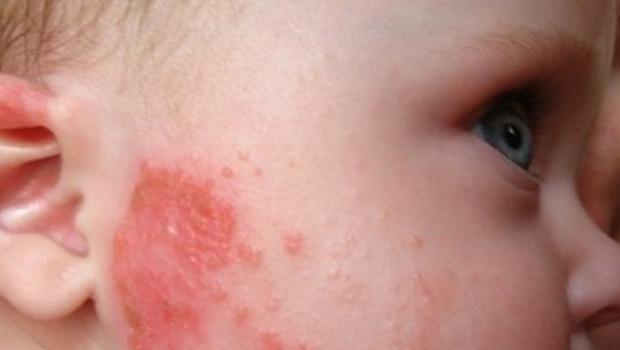 Виды аллергии у детей разного возраста