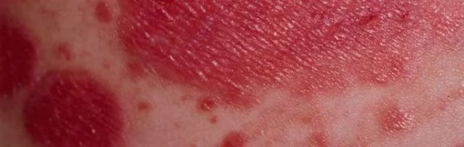 vörös foltok borítják a bőrirritációt